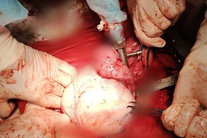 Саратовские врачи удалили пациентке гигантскую опухоль матки