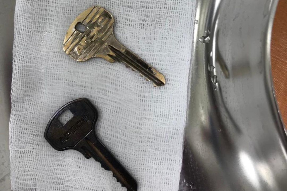 В Саратове врачи вытащили из желудка молодого человека два железных ключа размером пять сантиметров