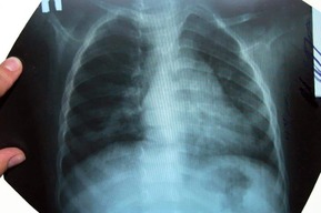 За сутки пневмонию выявили у 17 жителей Саратовской области больных ковидом