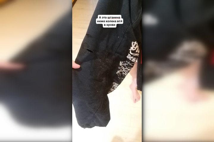 «Зашивали в нескольких местах под наркозом»: саратовчанка рассказала, как ее сын стал жертвой нападения бродячего пса