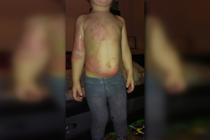 В Саратове двухлетний ребенок ошпарился кипятком в частном детском саду: спустя два года после ЧП суд отложил рассмотрение дела