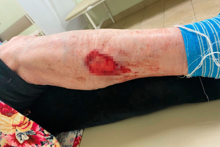 «Выгрызла кусок мяса»: пенсионерка попала в больницу после нападения собак в Заводском районе