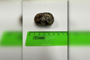 Врачи балаковской больницы извлекли из кишечника 86-летней пациентки камень аномальных размеров
