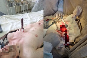 В марксовскую больницу привезли молодого человека с ножом, торчащим в груди 