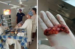 У жителя Петровска нашли гангренозный аппендицит, перитонит и грыжу: история спасения
