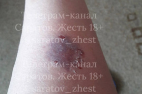 «Вышла вынести мусор и попала в ад»: в Саратове возбудили уголовное дело после нападения стаи собак на женщину 