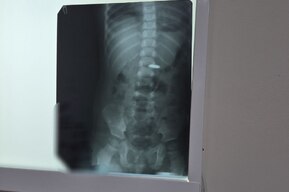 «Мгновенный урон»: врачи из балаковской больницы спасли годовалого ребенка, проглотившего батарейку