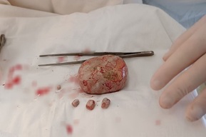 Уникальный случай: в теле балаковца вырос гигантский камень весом более килограмма