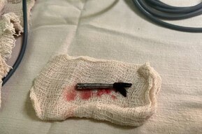 Рыбные кости и кисточка: врачи рассказали о спасении детей, проглотивших различные предметы