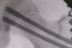 «Счёт шёл на часы»: в областную больницу доставили 13-летнего мальчика, серьезно пострадавшего из-за любви к «высоким скоростям»