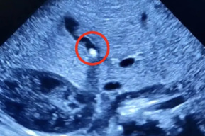 Второй случай за 30 лет практики: у полуторамесячного мальчика в жёлчном пузыре нашли камень