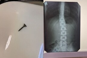 Двухлетний мальчик проглотил саморез, а 20-летняя девушка — металлический пирсинг: врачи рассказали о необычных клинических случаях