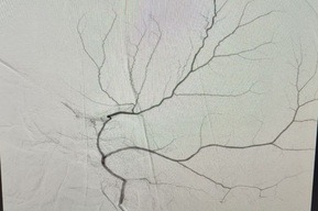 В Балаково провели революционную операцию на молодом пациенте с гематомой, сдавливавшей мозг