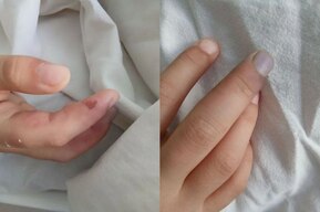 В Саратове спасли девочку с заболеванием, которое встречается в 2–18 случаях на миллион населения