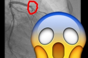 Житель Балаково убирал снег, почувствовал острую боль и чуть не умер из-за «артерии вдов»