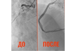 К балаковским медикам пришёл пациент с «сердцем старика в 32 года»: история спасения