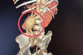 Балаковские врачи обнаружили в теле пациентки «бомбу замедленного действия»