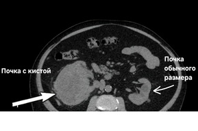 Киста на 400 миллилитров с инфекцией, которую не берут антибиотики: история спасения жителя Балаково