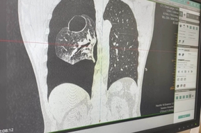 Коллапс легкого, резкое затруднение дыхание, кислородное голодание: мужчина средних лет пришёл на консультацию и внезапно узнал об опасном диагнозе