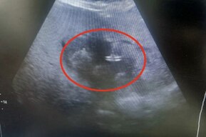 Врачи спасли 83-летнюю женщину с абсцессом печени, выявленном после двух недель высокой температуры