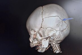 Младенца из Балаково, упавшего с кровати, срочно доставили санавиацией в Саратов с переломом кости черепа