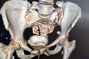 Перелом таза и разрыв мочевого пузыря: врачи спасли мужчину, который попал в серьёзную аварию