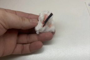 Балаковские медики извлекли из руки у мальчика кусок дерева. Изначально у него было подозрение на перелом