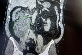 «Живот стал асимметричным, каждое движение доставляло мучение»: врачи рассказали о редком случае, когда в организме саратовца скопилось полтора литра мочи