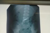 «Пришлось развернуть целую тактическую операцию»: в Балаково спасли двух детей, которые проглотили монеты