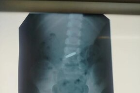 «Пришлось развернуть целую тактическую операцию»: в Балаково спасли двух детей, которые проглотили монеты